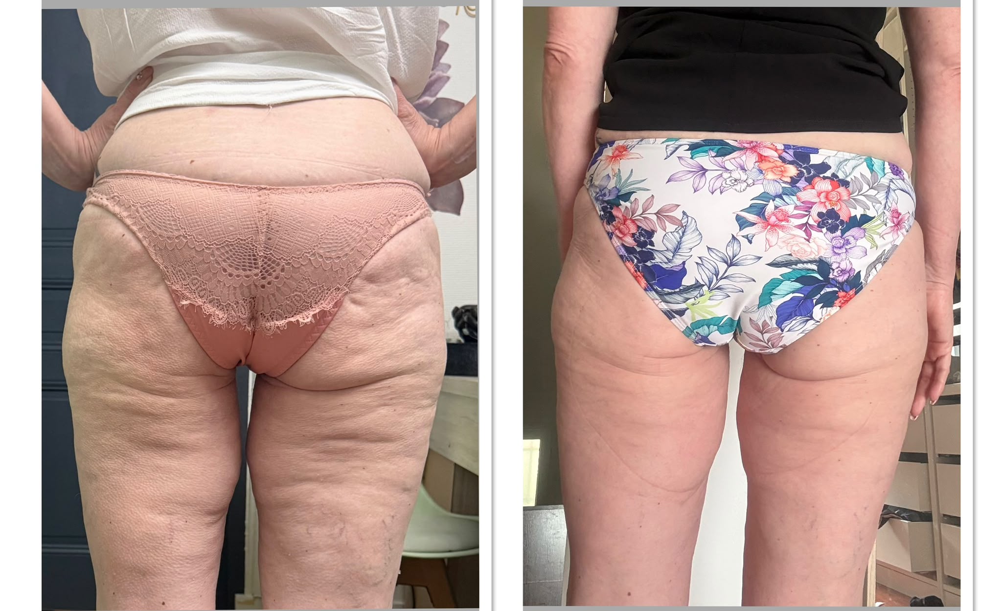 Résultat avant après cryolipolyse cuisses culotte de cheval fessiers